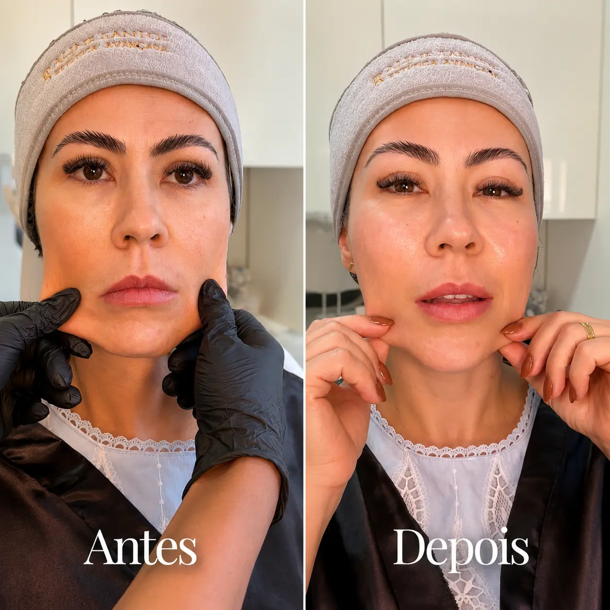 Antes e depois do tratamento com bioestimuladores de colágeno