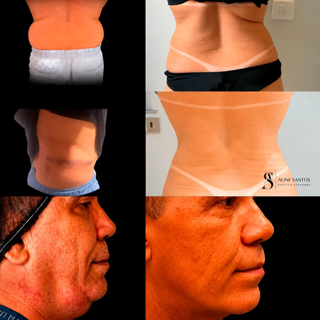 Antes e depois do tratamento com Endolaser