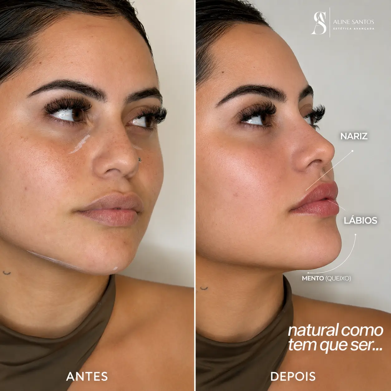 Antes e depois da harmonização facial